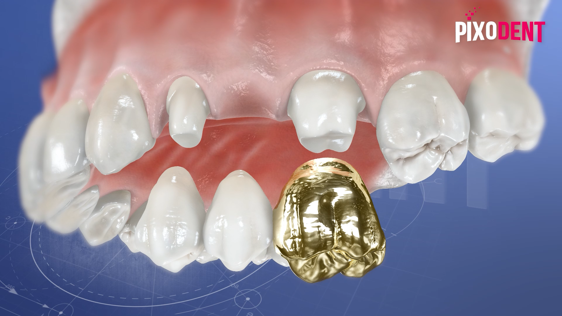 Fixed Prosthodontics