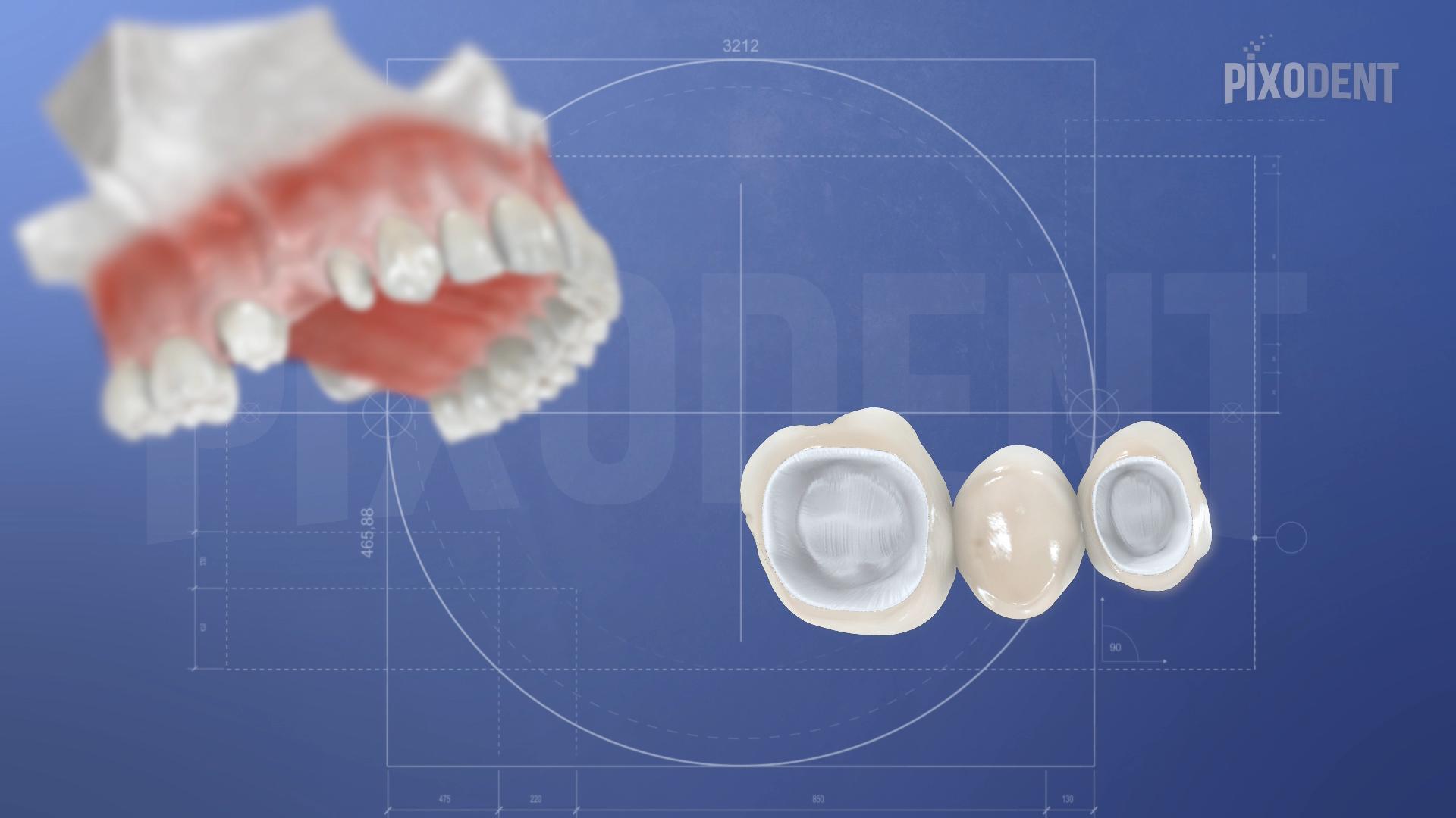 Bridge Zirconia
