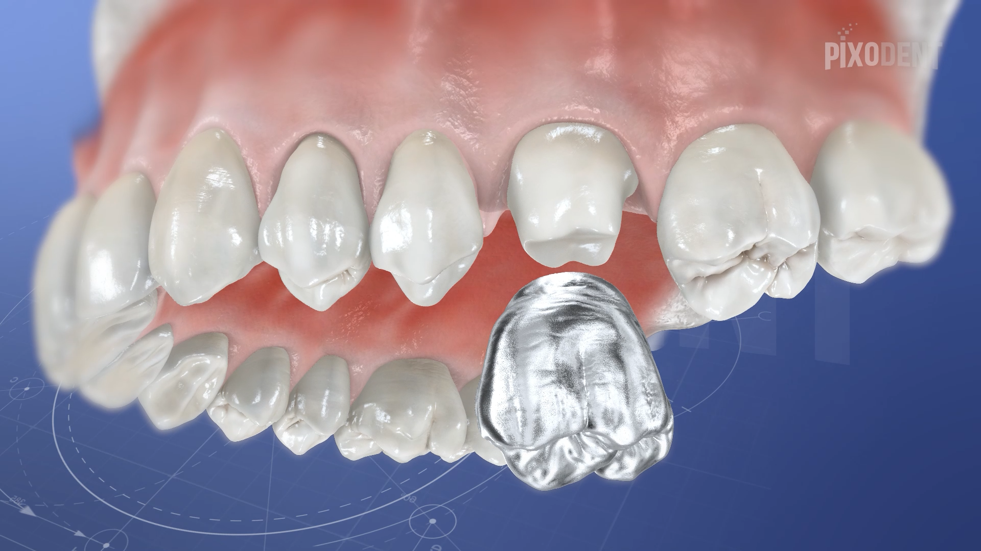Crown Metal