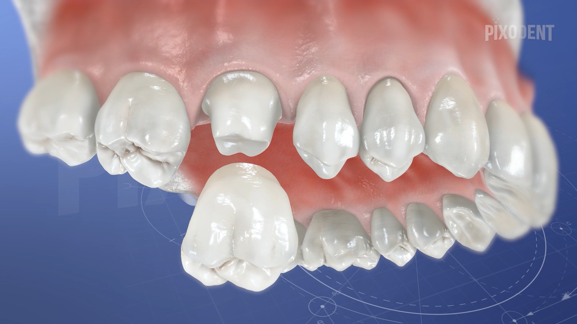Crown Metal Ceramic