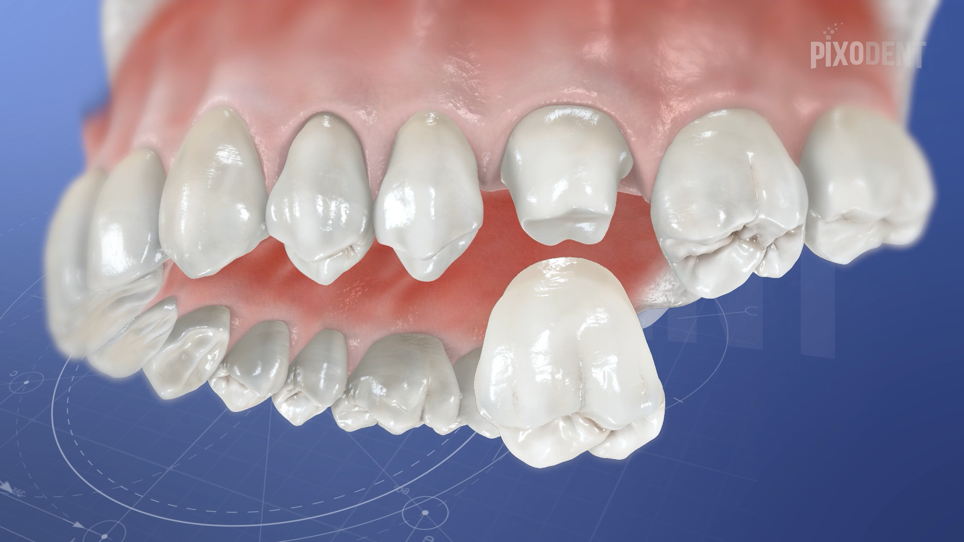 Crown Zirconia
