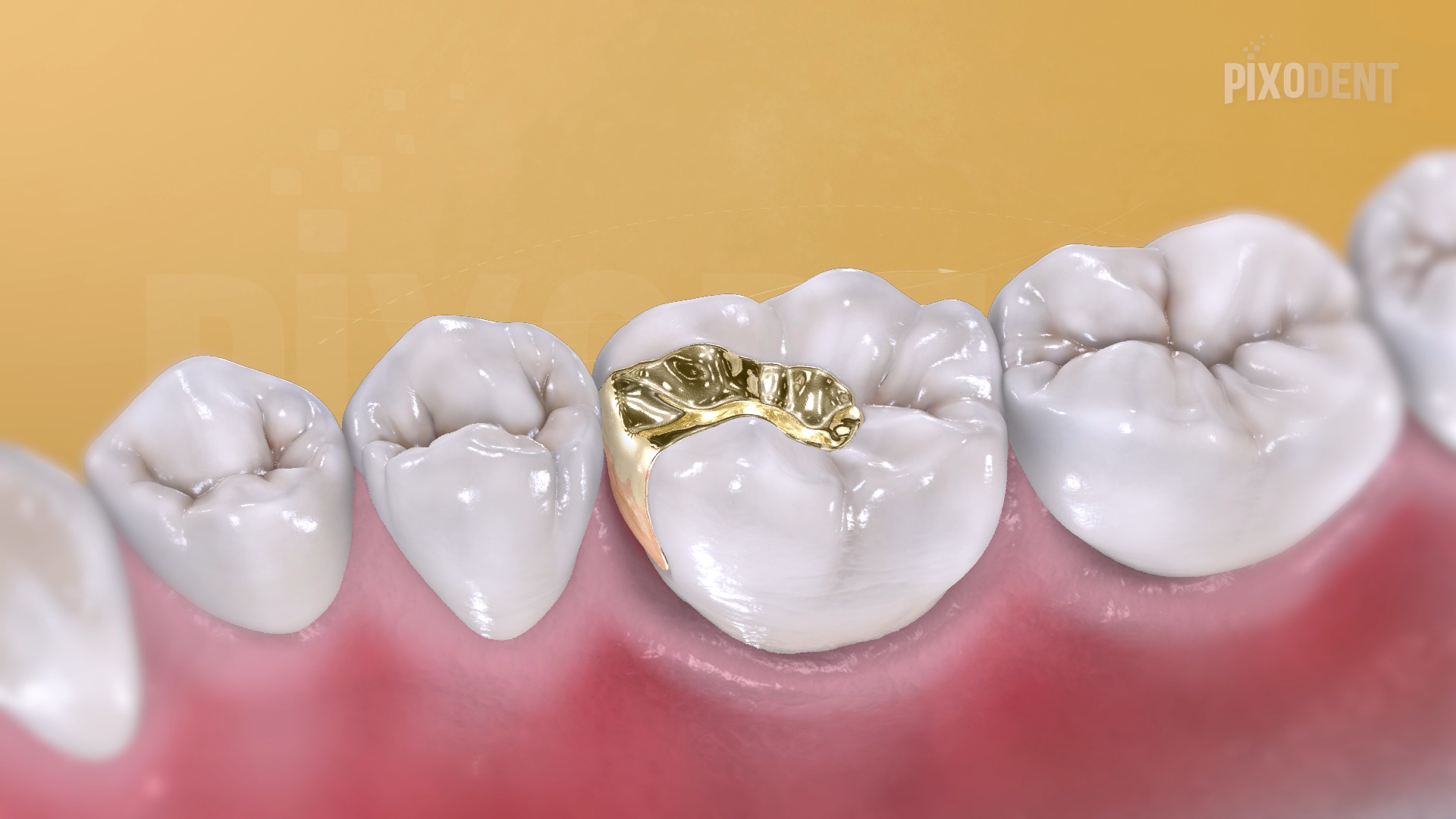 Fillings Class II Cast Gold