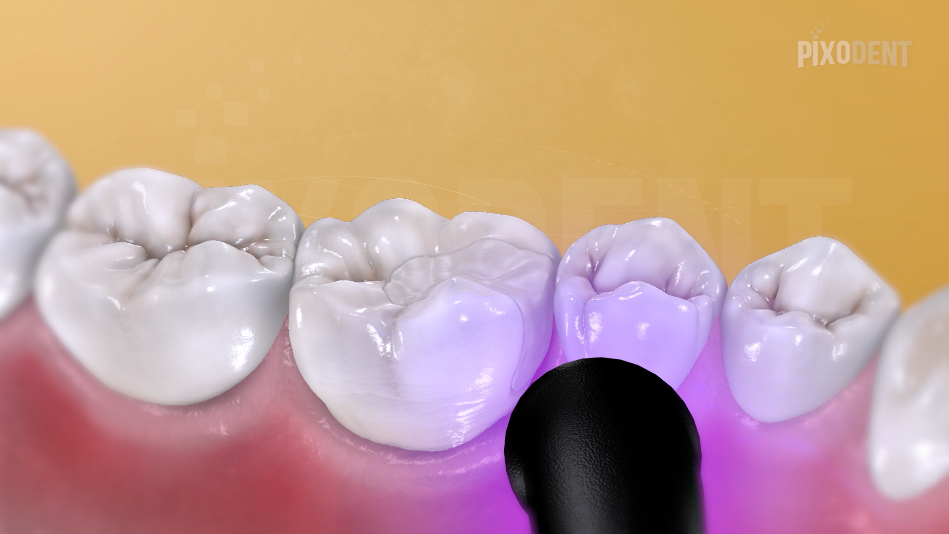 Fillings Class II Composite
