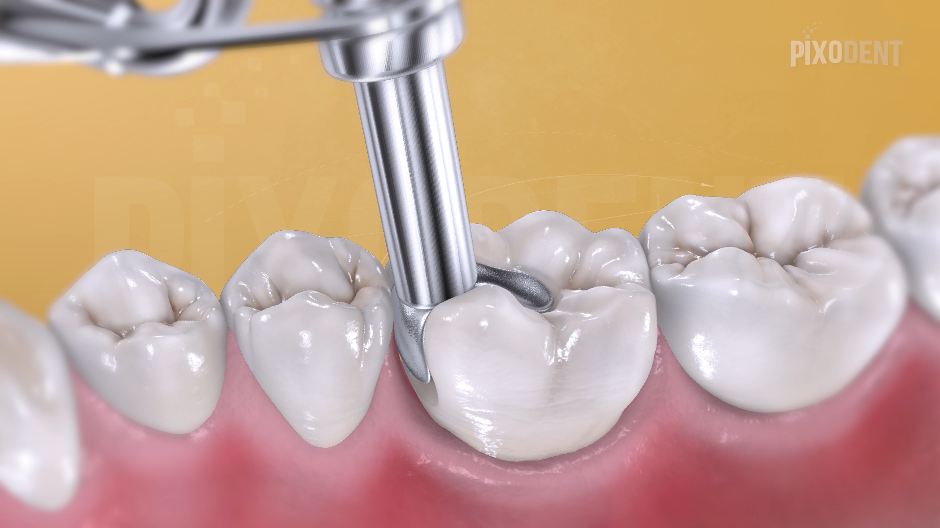 Fillings Class II Silver Amalgam
