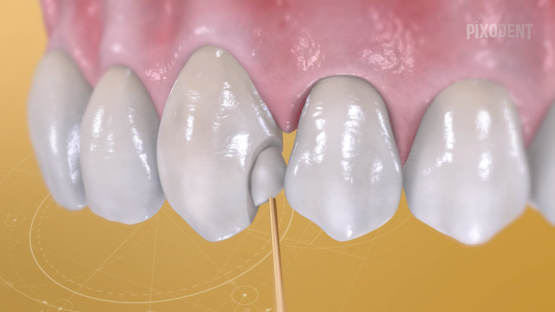 Fillings