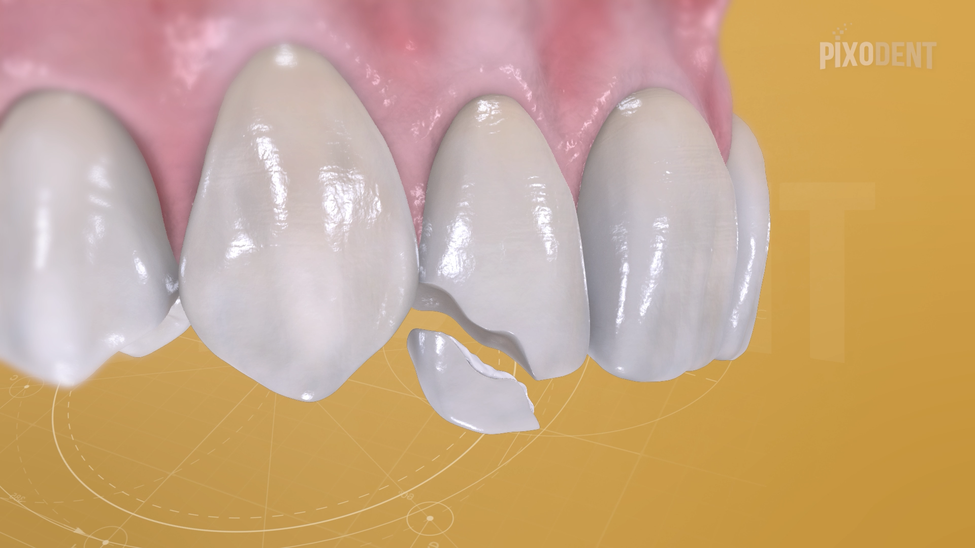 Fillings Class IV Fragment