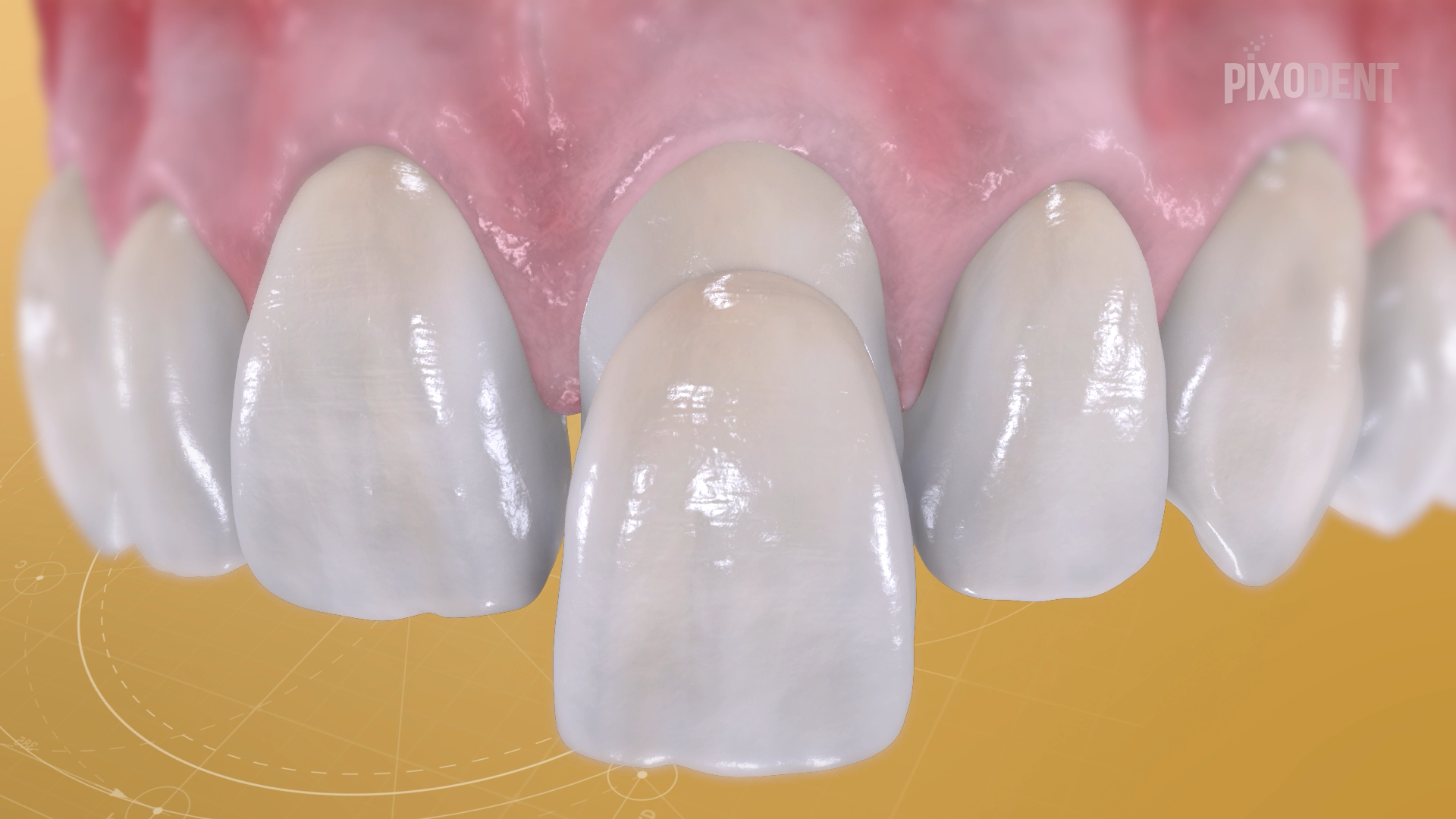 Fillings Class IV Veneer