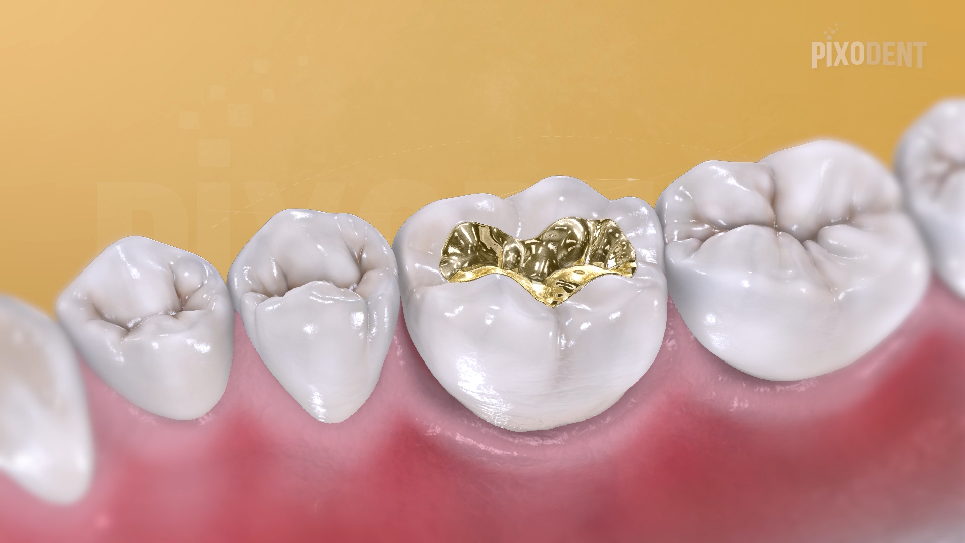 Fillings Class I Cast Gold
