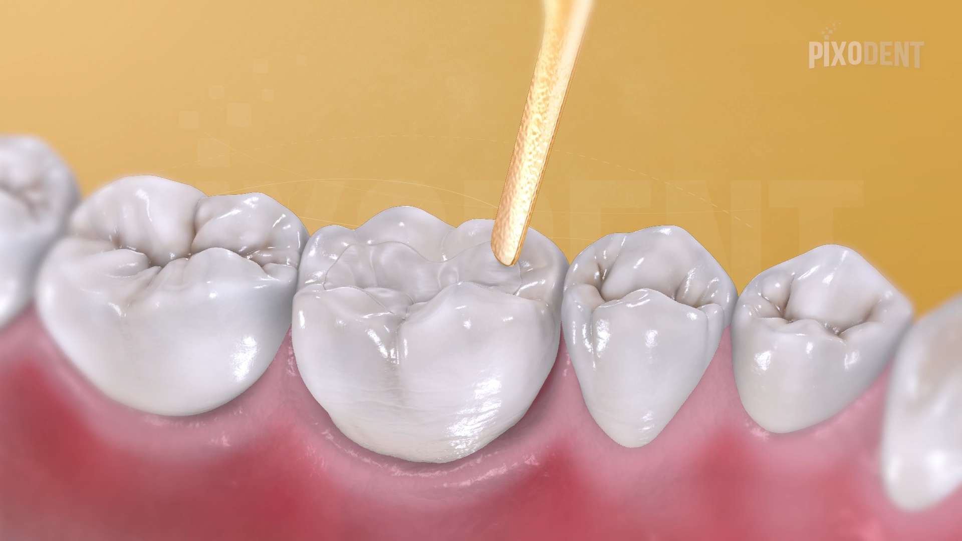 Fillings Class I Composite