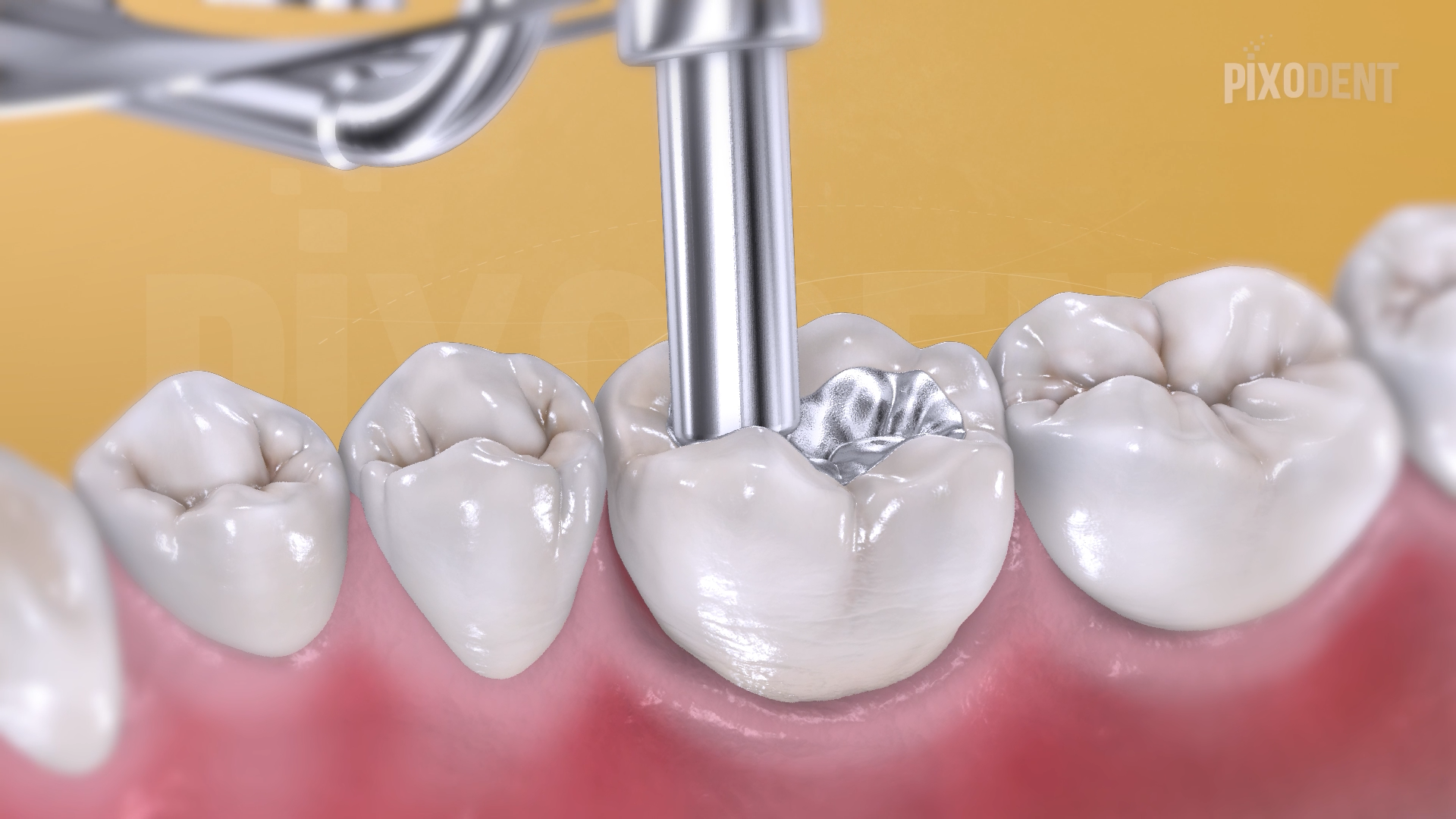 Fillings