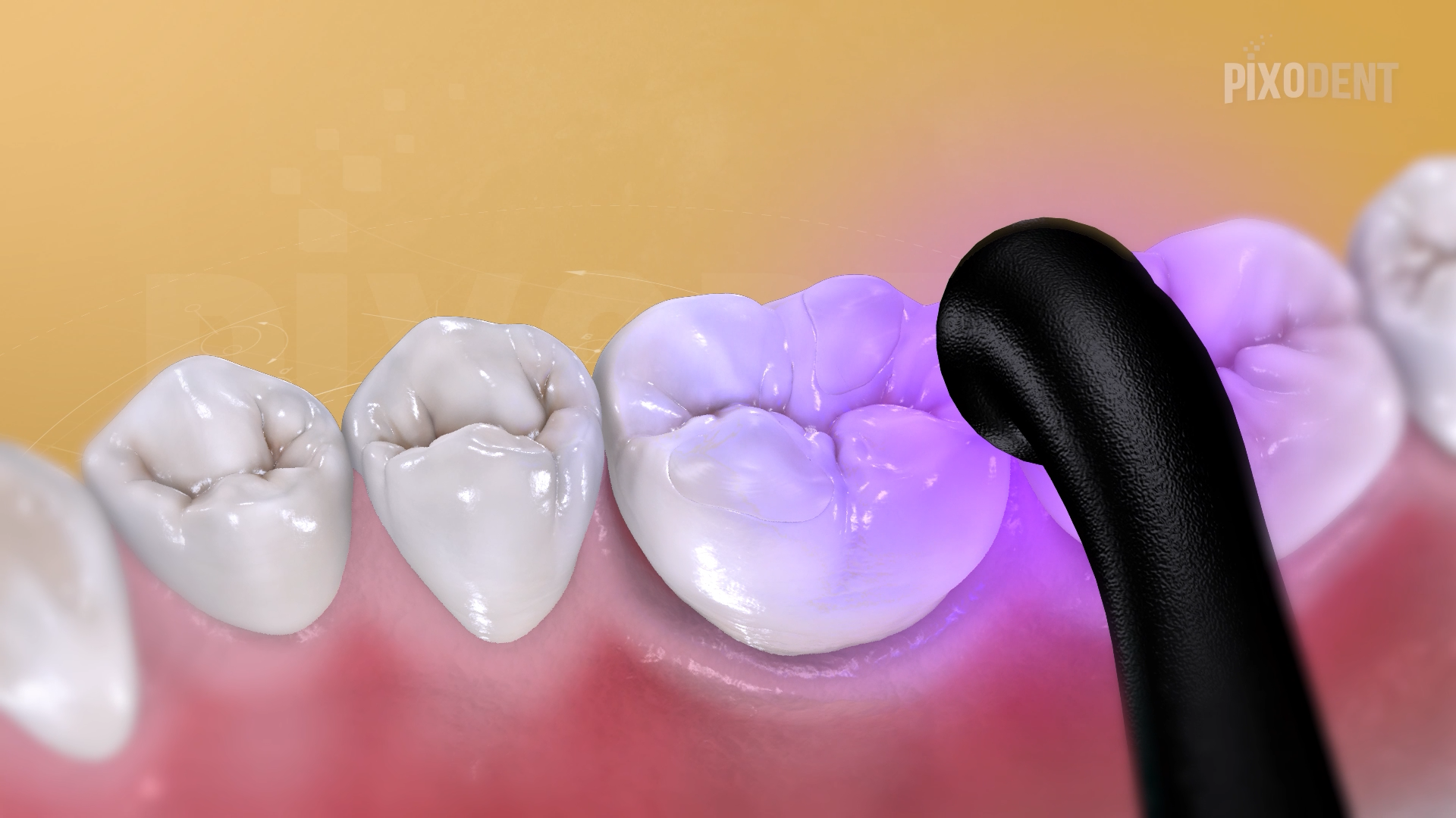 Fillings