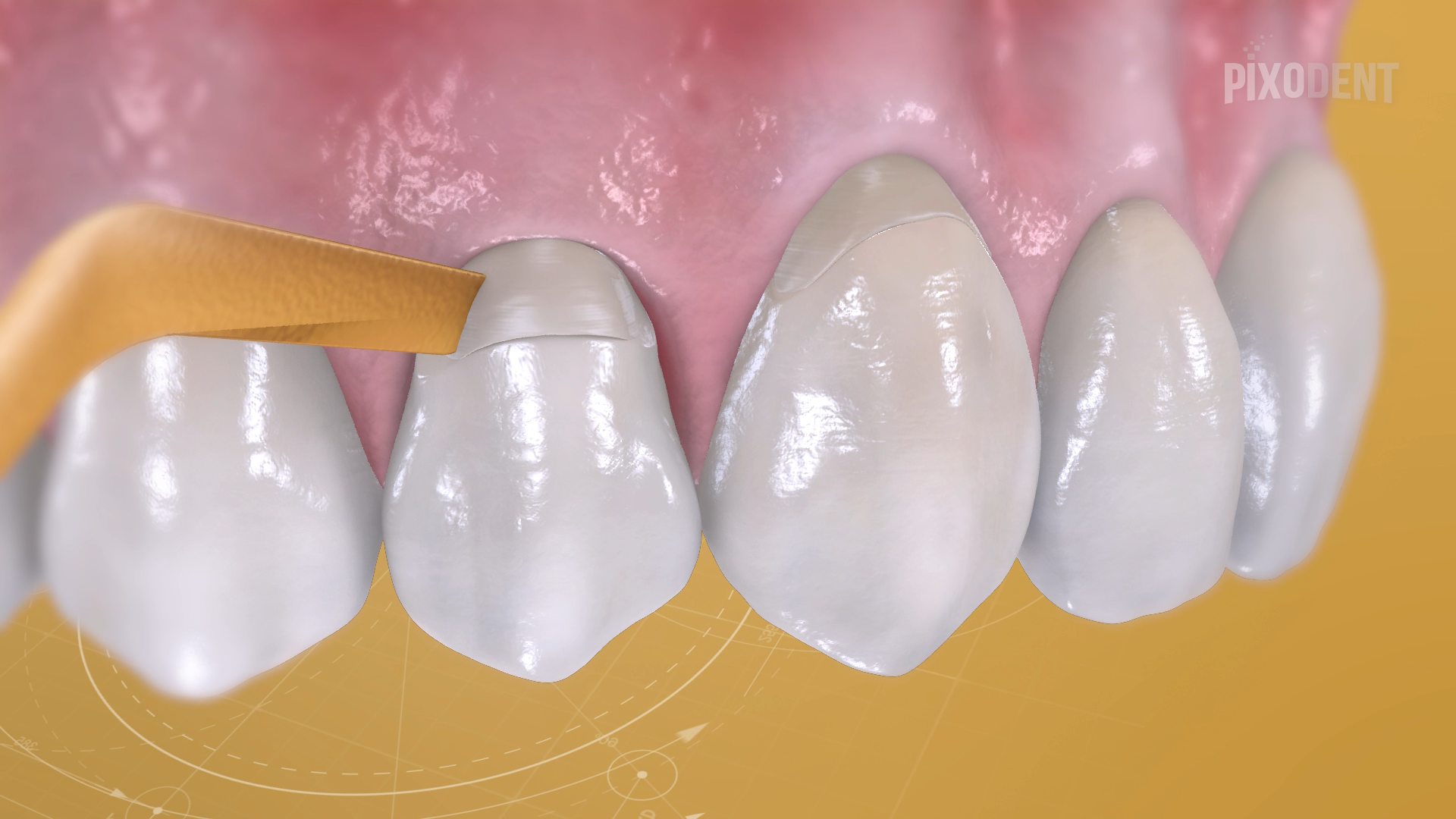 Fillings Class V Composite
