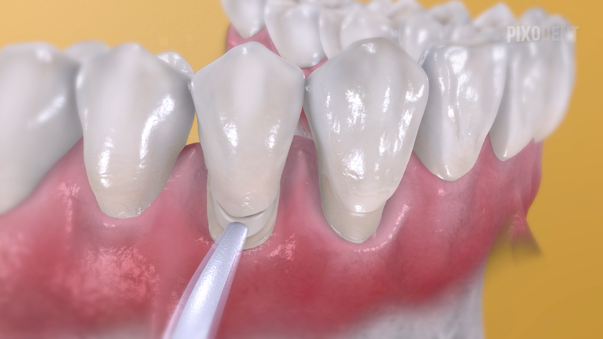Fillings