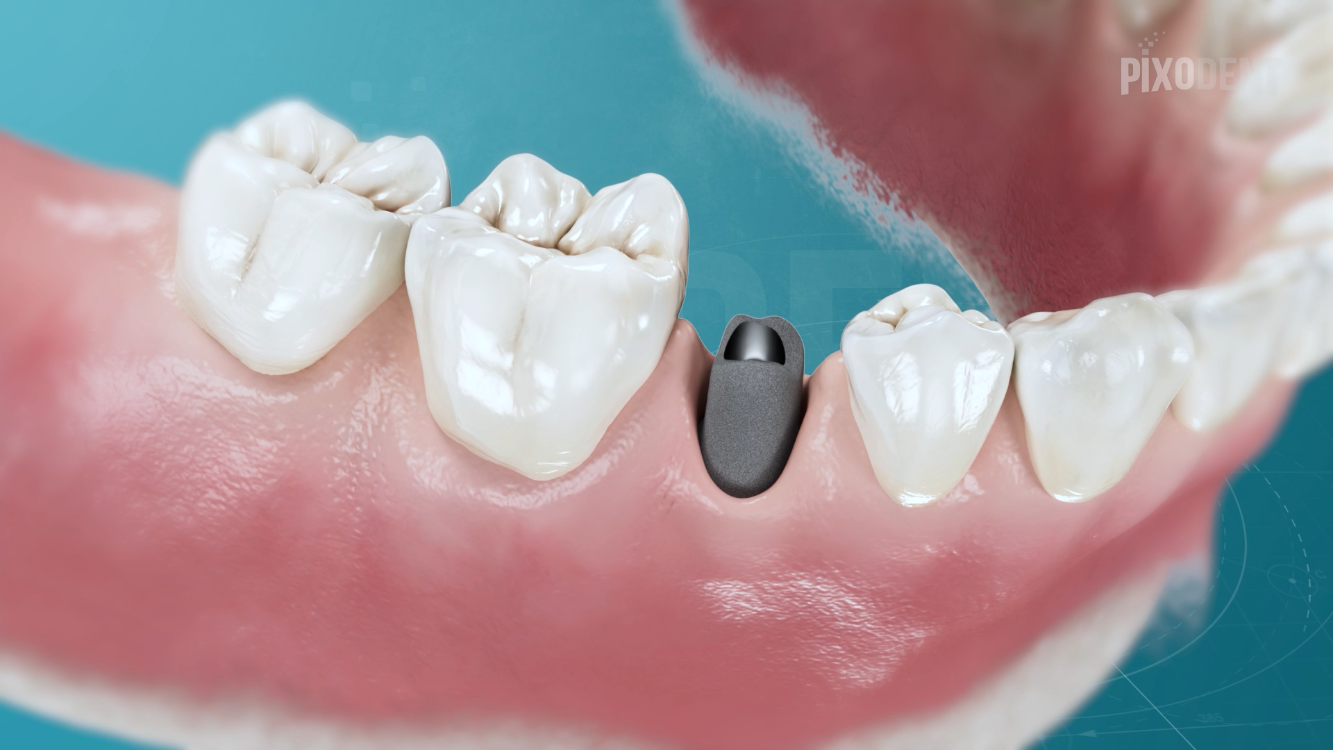 Implants