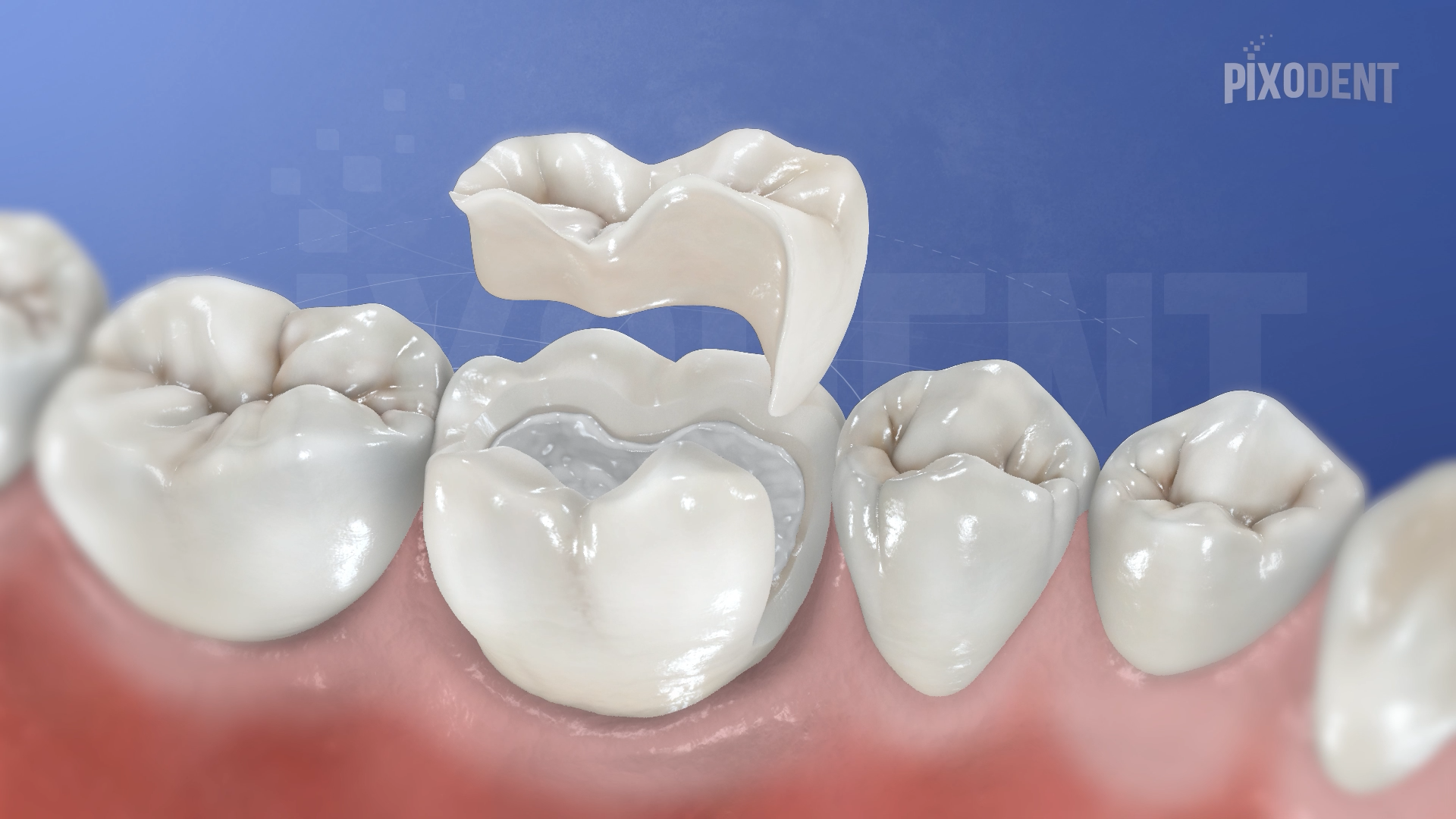 Inlay Ceramic