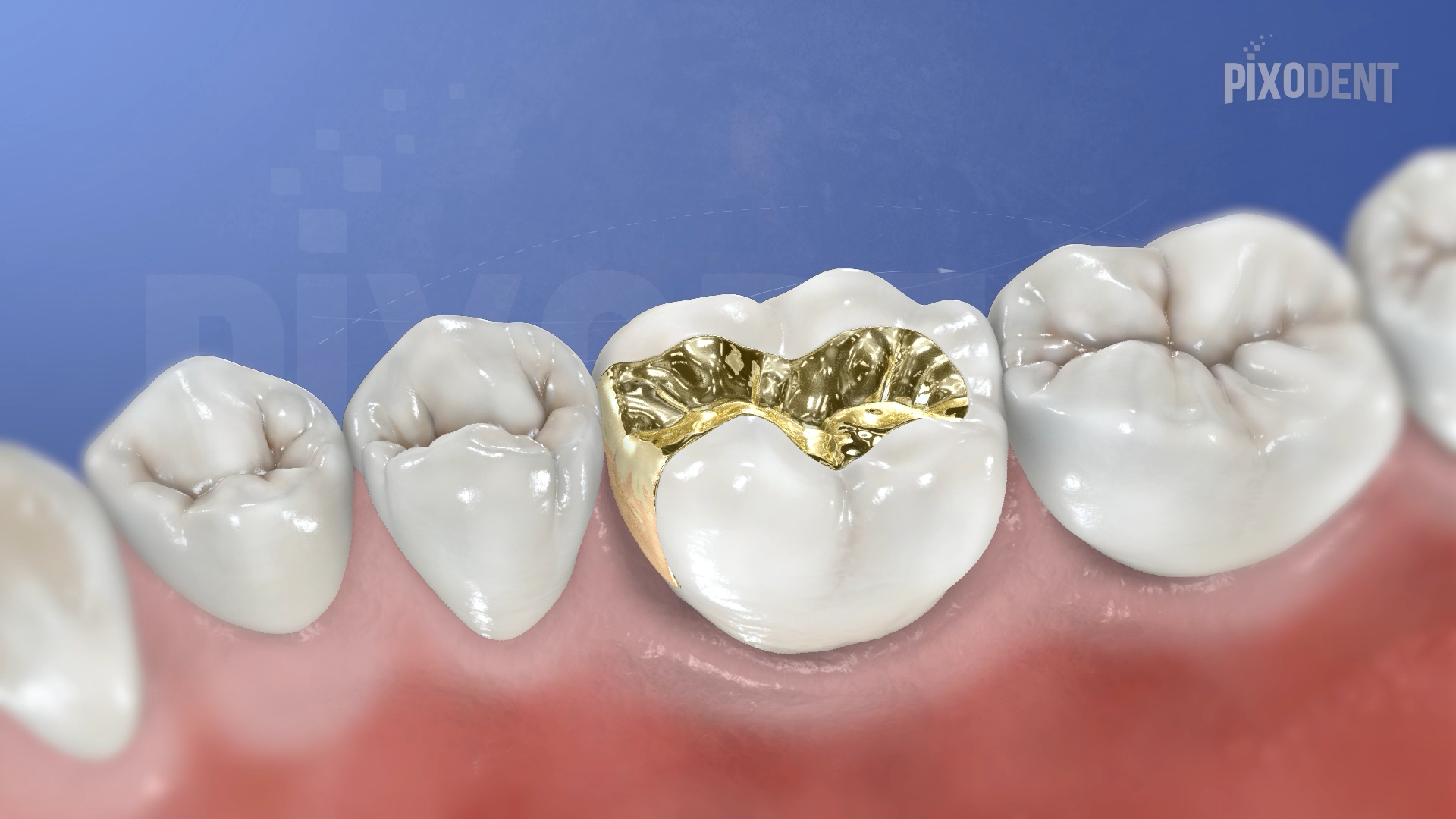 Fixed Prosthodontics