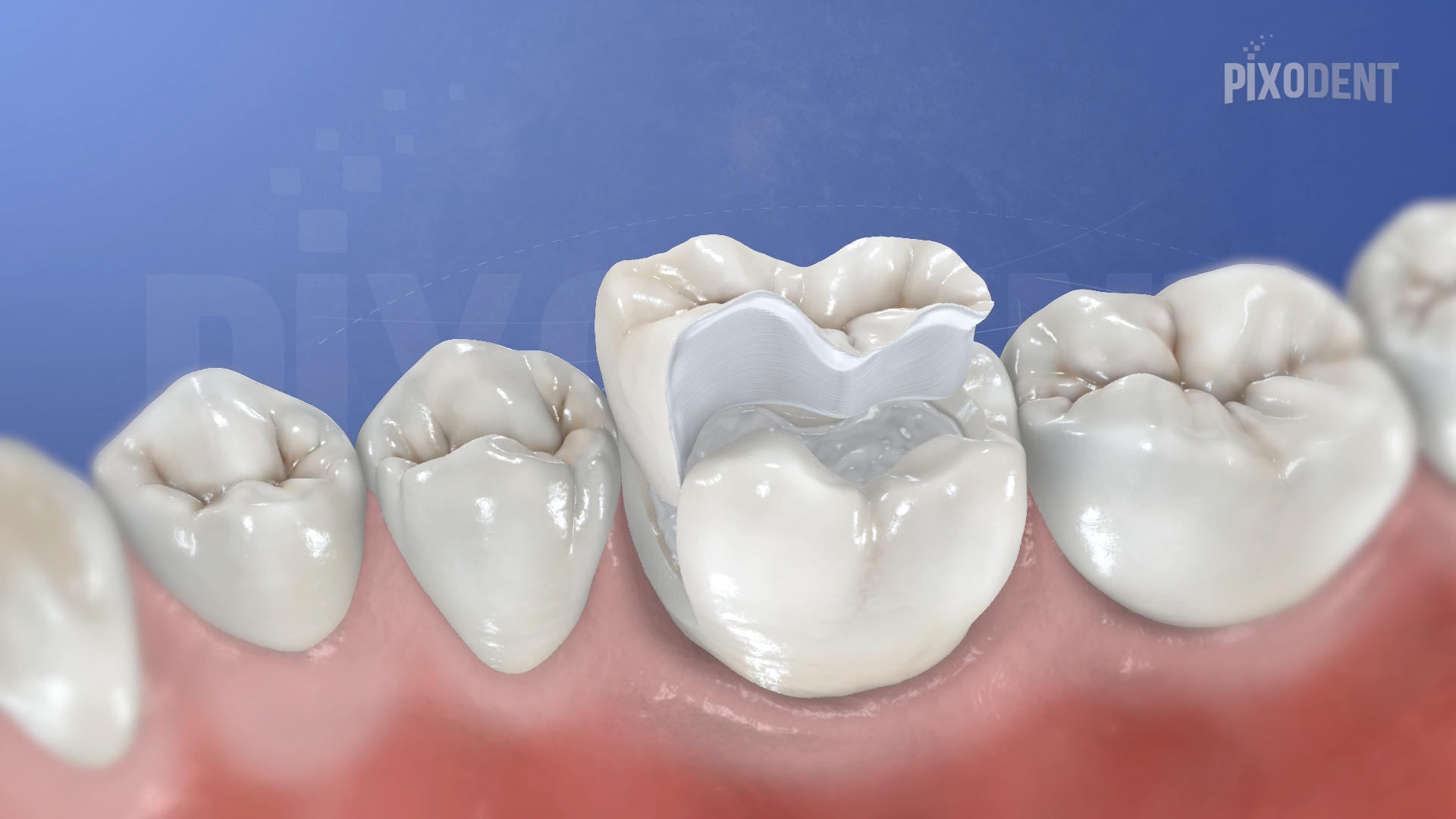 Fixed Prosthodontics