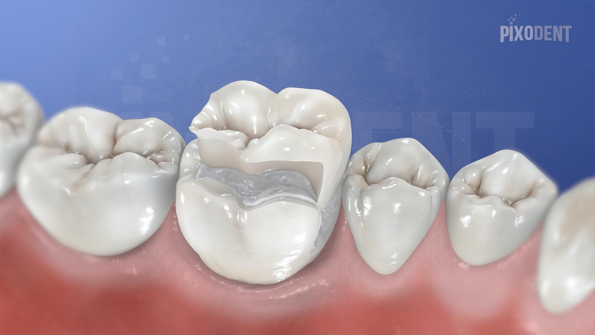 Onlay Ceramic