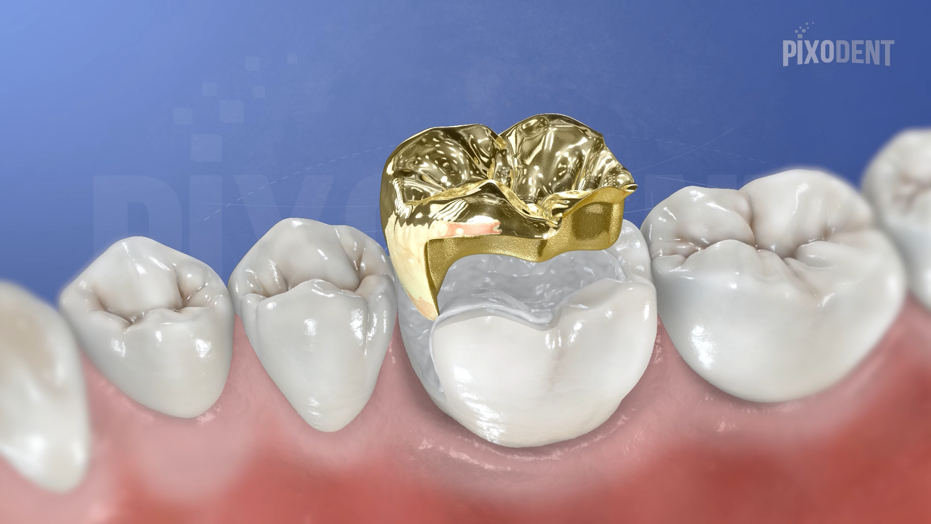 Onlay Gold