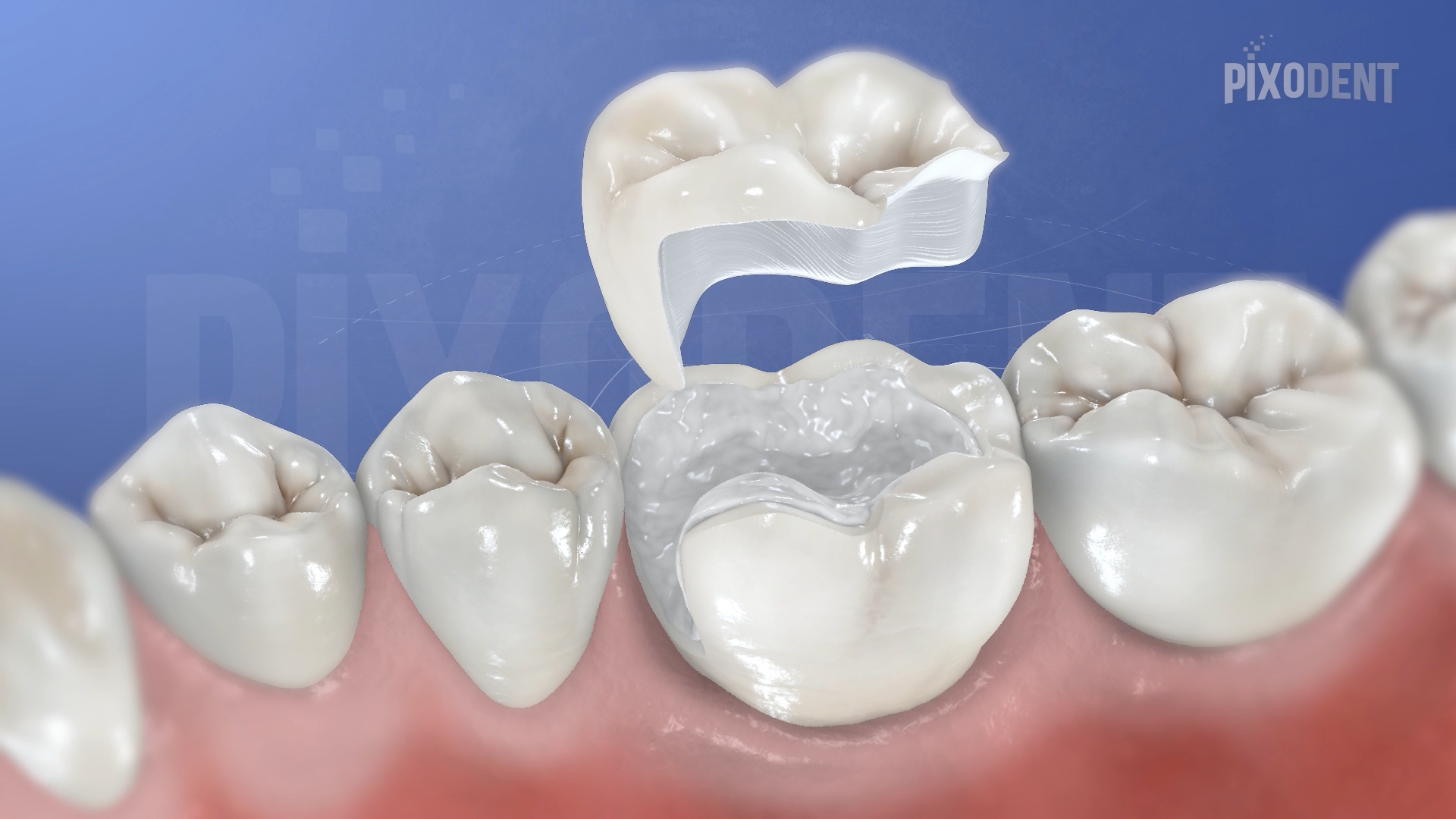 Onlay Zirconia