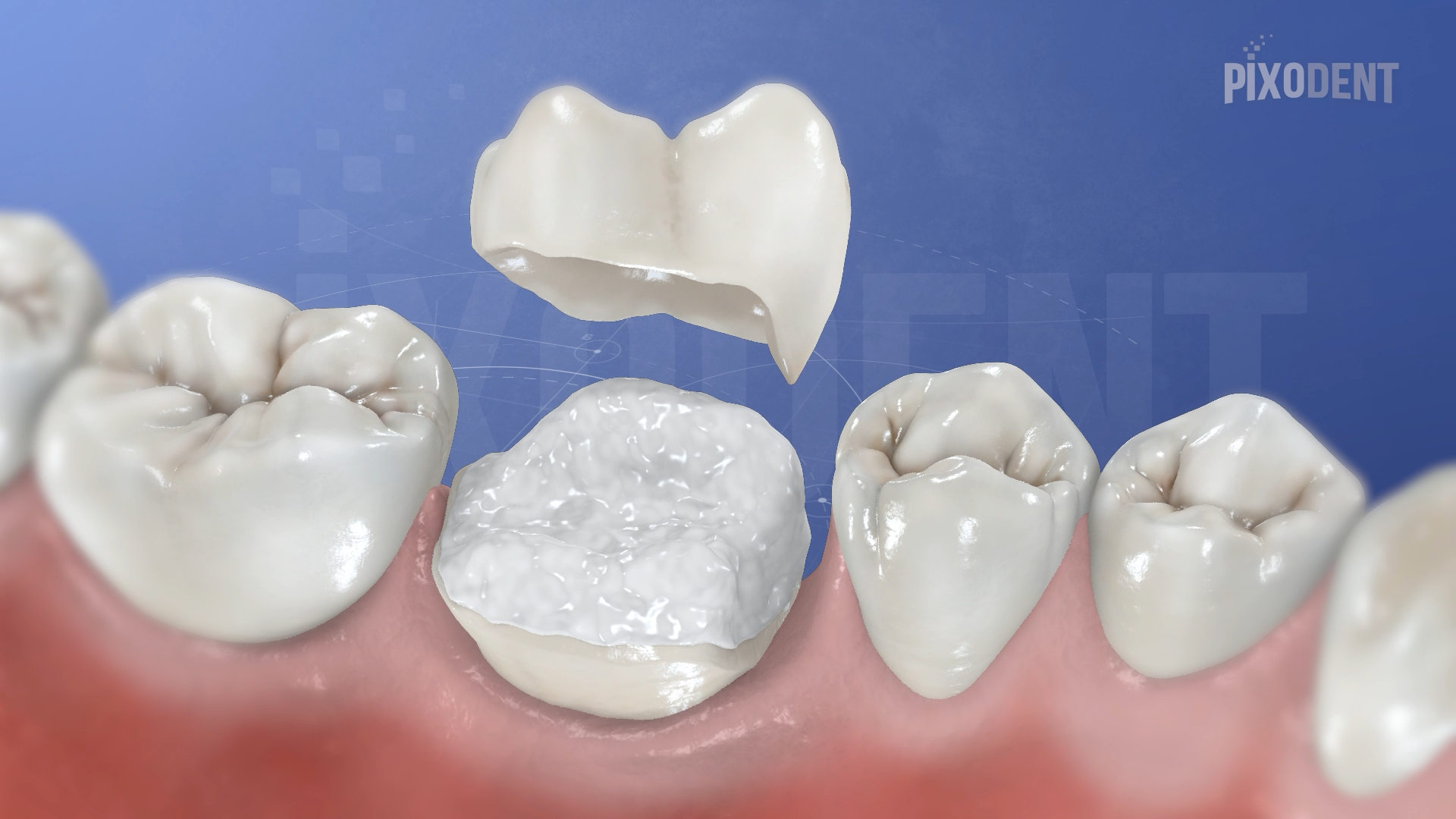 Overlay Ceramic