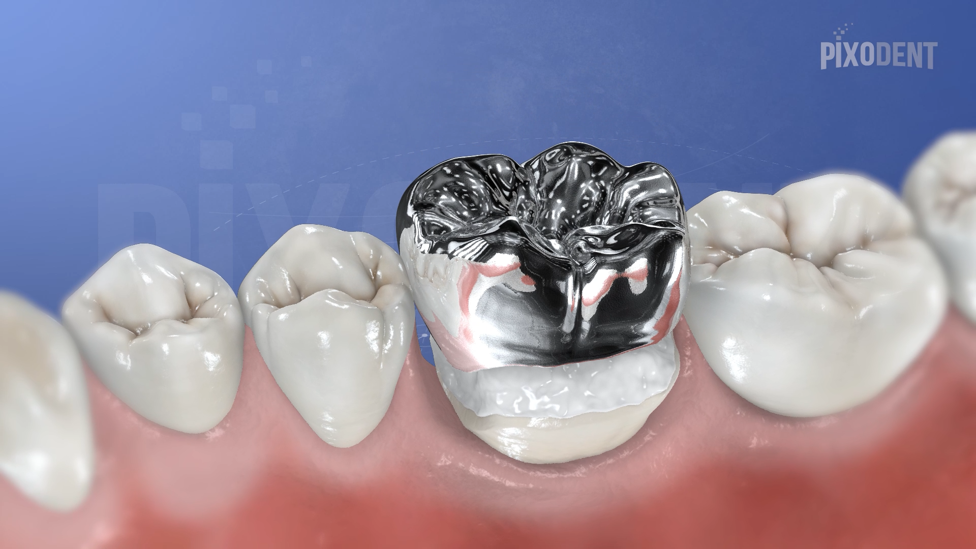 Fixed Prosthodontics