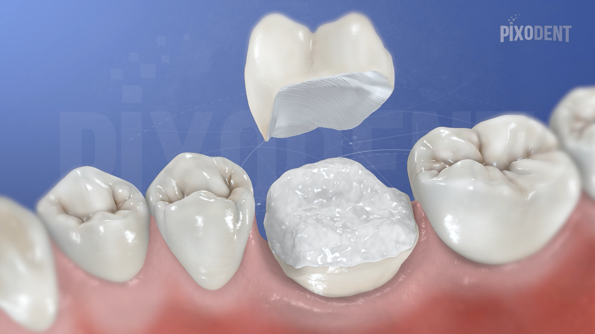 Overlay Zirconia