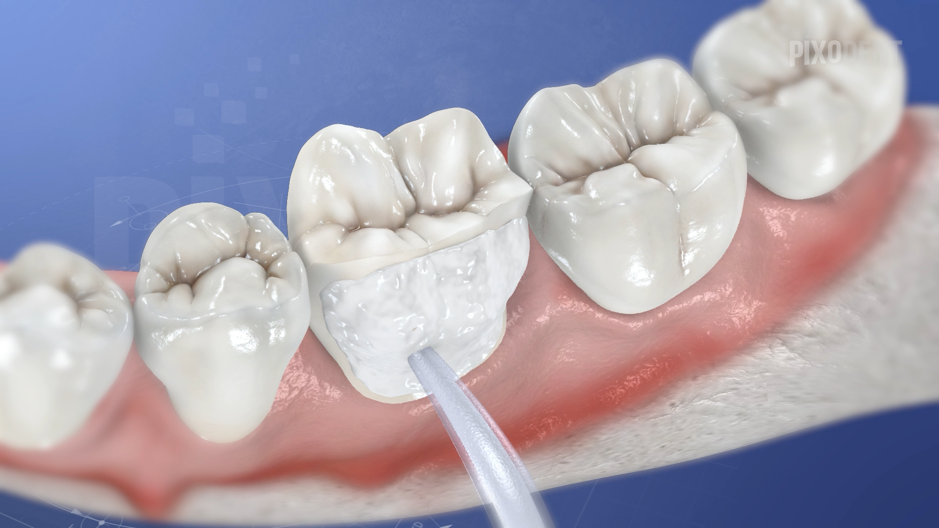 Fixed Prosthodontics