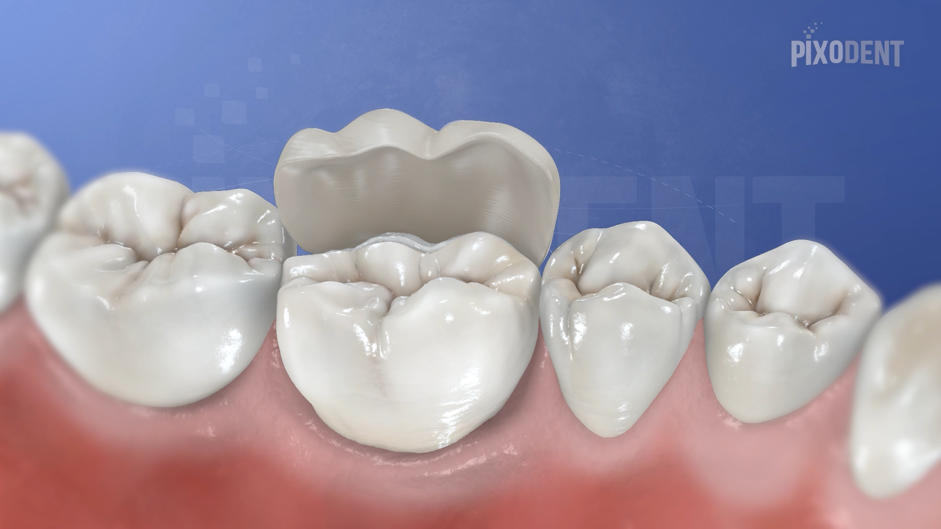 Veneer Composite
