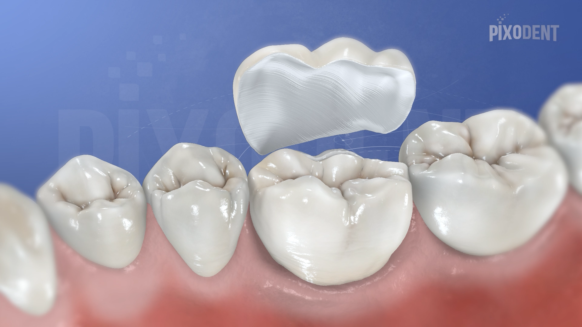 Veneer Zirconia