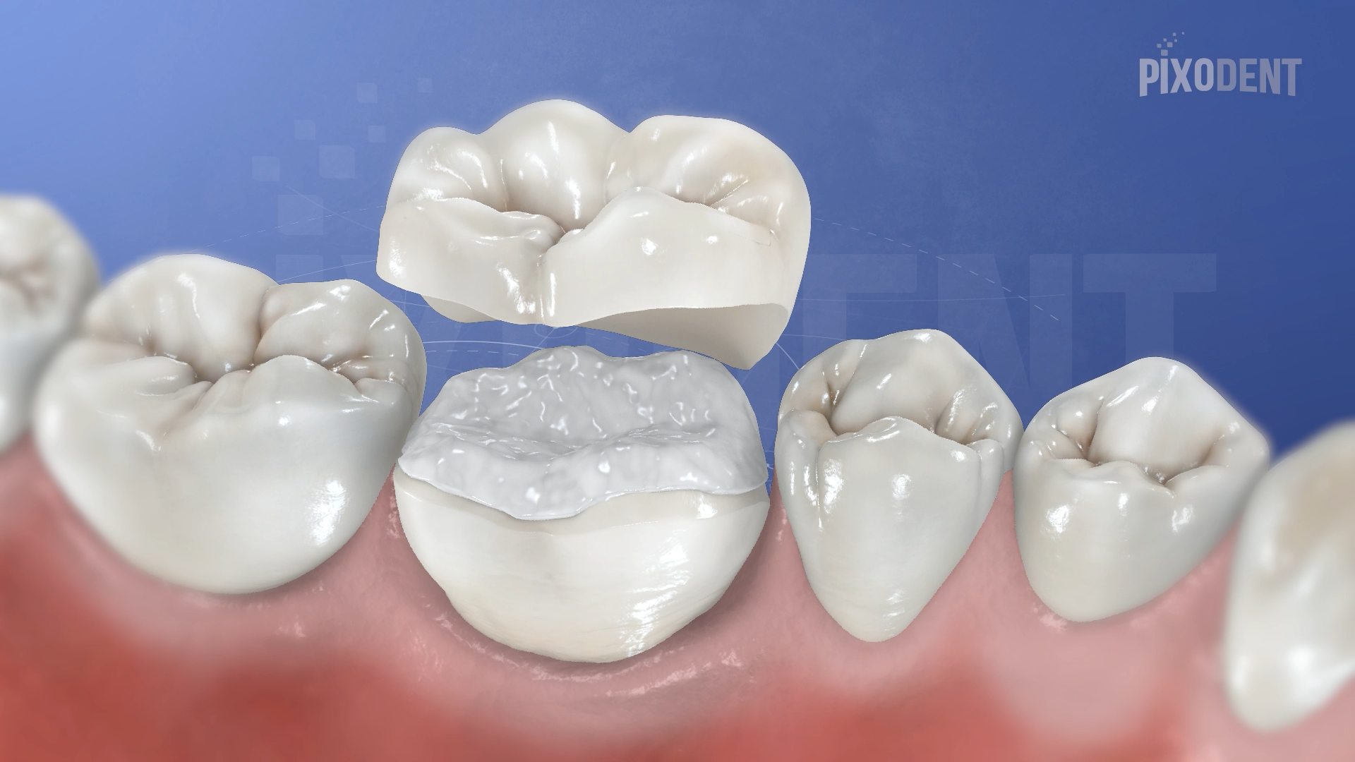 Veneerlay Ceramic