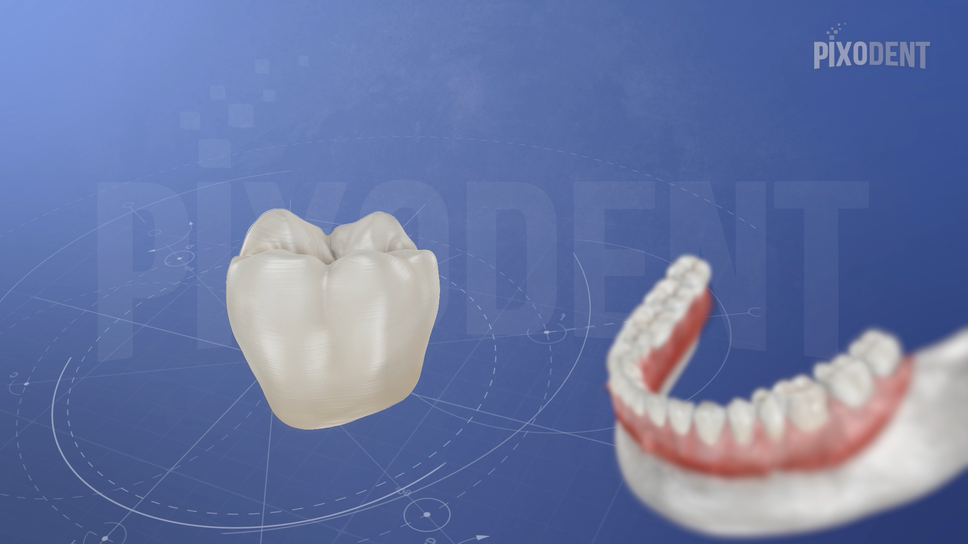 Veneerlay Composite