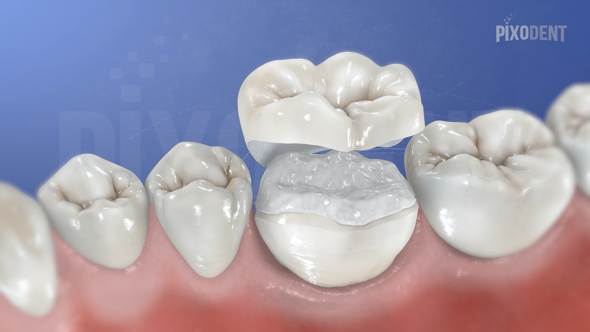 Veneerlay Zirconia